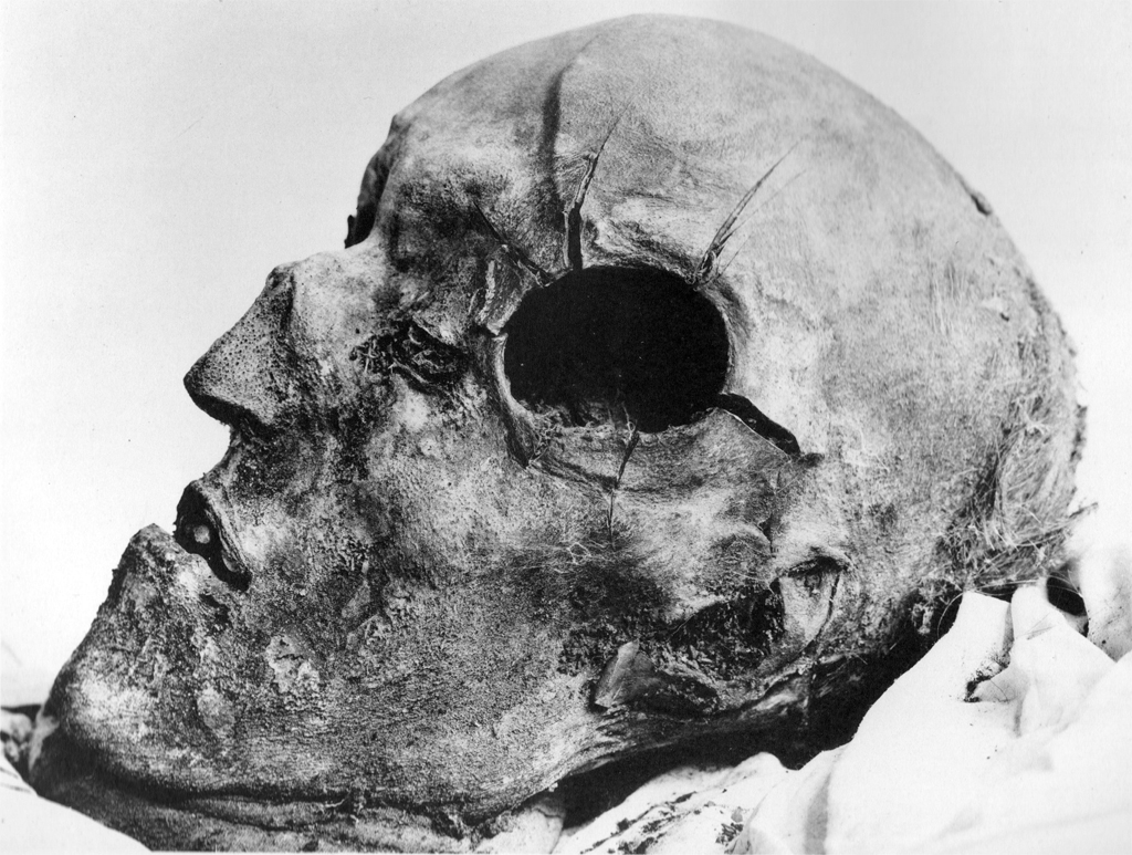 Karl XII:s kranium fotograferat vid gravöppningen 1917.